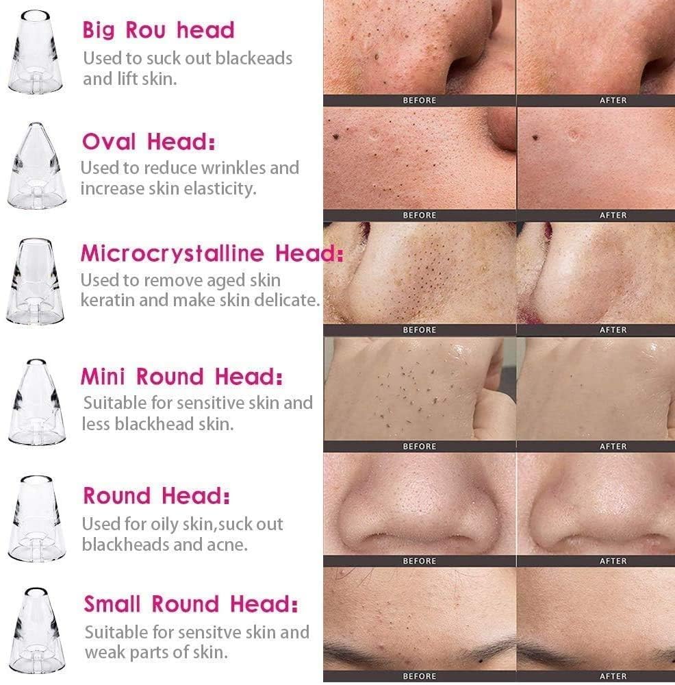 "GlowSkin™ Portable Blackhead Remover"